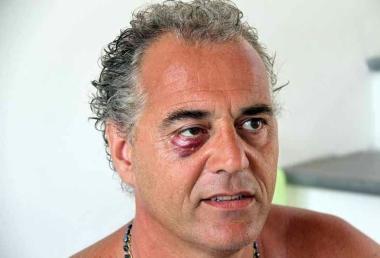Fabio Buonaccorsi ha un grosso livido all’occhio destro