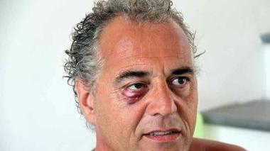 Fabio Buonaccorsi ha un grosso livido all’occhio destro