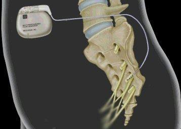 Ecco come funziona il pacemaker per il trattamento dell incontinenza dei disturbi funzionali intestinali 