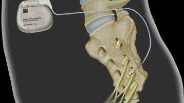 Ecco come funziona il pacemaker per il trattamento dell’ incontinenza dei disturbi funzionali intestinali