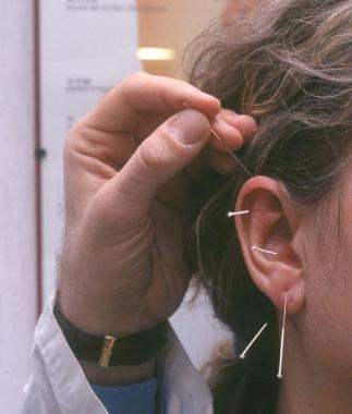 <b>AGOPUNTURA </b>Una delle medicine alternative praticate allospedale di Pitigliano 