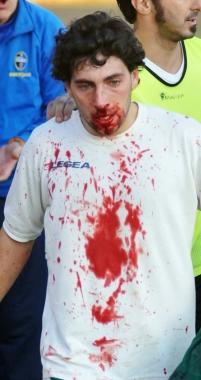 <b>SAN DONATO</b> La maschera di sangue di Matteo Pira ieri in campo per la partita di Coppa Toscana a Piombino        