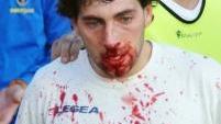 <b>SAN DONATO</b> La maschera di sangue di Matteo Pira ieri in campo per la partita di Coppa Toscana a Piombino