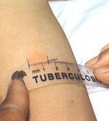 Farmaco riattivò la tubercolosi condannato reumatologo 