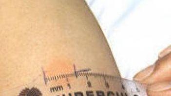 Farmaco riattivò la tubercolosi condannato reumatologo