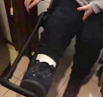 Barriere nella casa popolare dove vive la disabile: è scontro 