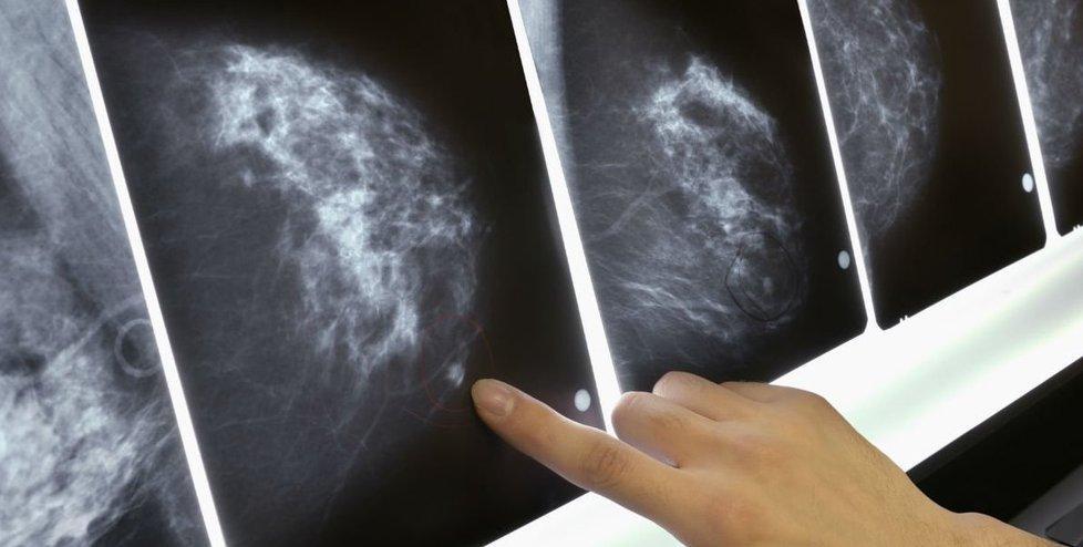 Ogni anno 650 tumori al seno Dieci casi riguardano i maschi 