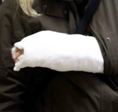 <b>INGESSATO </b>Il braccio ferito durante il blitz di luned&igrave; in piazza Attias 
