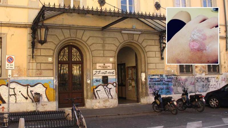 Studente marchiato a fuoco dal bullo: minacciato, deve cambiare scuola e città