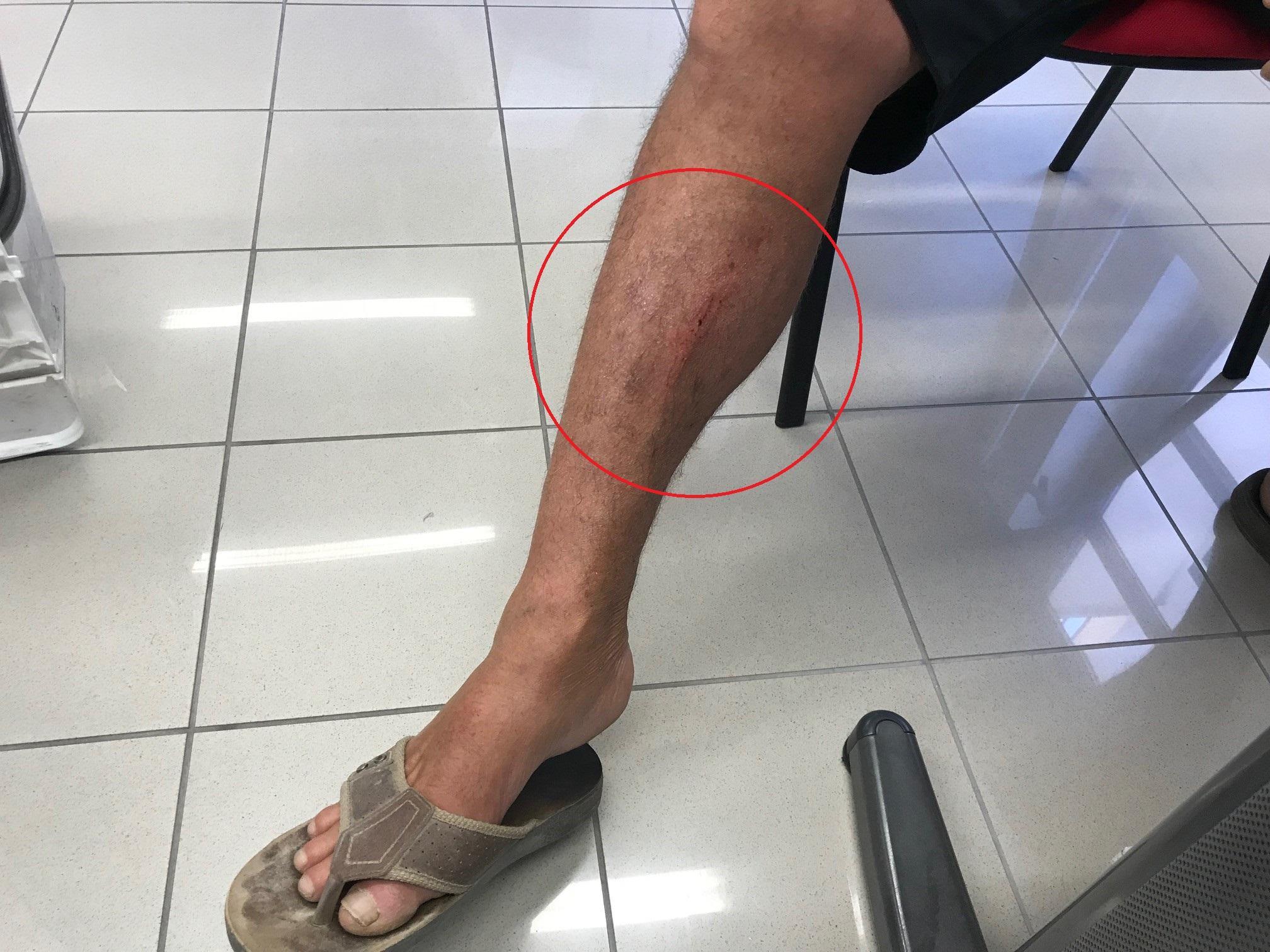 Graffiato da un cane in spiaggia a Fiumara: «E meno male che voleva giocare...» 