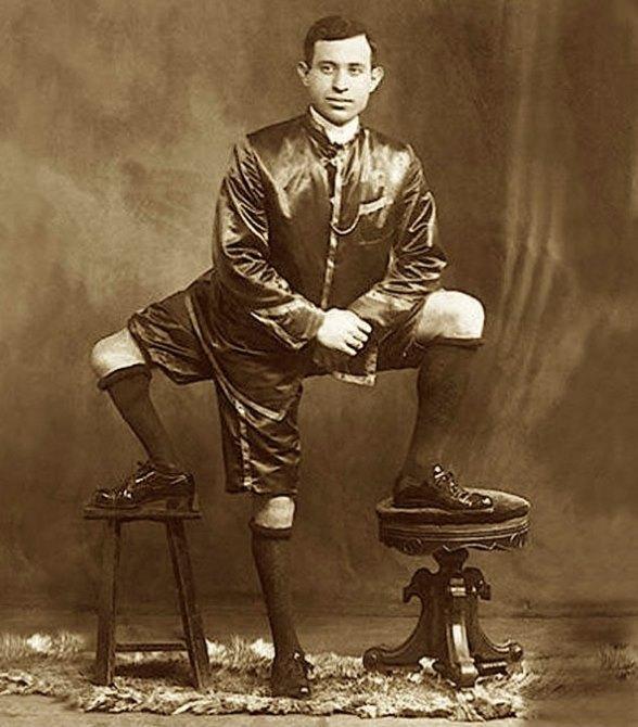 U Meravigghiusu “Frank Tre Gambe”, il bambino ripudiato diventò una celebrità 
