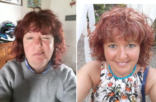 «Mi sono svegliata col volto paralizzato, all’ospedale di Cecina mi hanno salvata» 