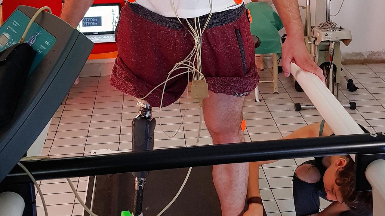 «Sento gamba e piede»: la protesi del S. Anna supera l’amputazione