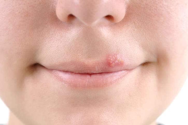 L’herpes labiale colpisce quasi sempre sulle labbra ma attenti a viso o genitali