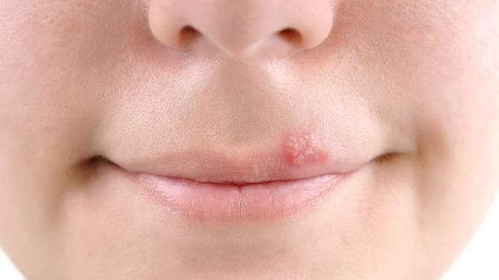 L’herpes labiale colpisce quasi sempre sulle labbra ma attenti a viso o genitali