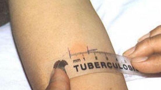 Il test di Mantoux contro la tubercolosi