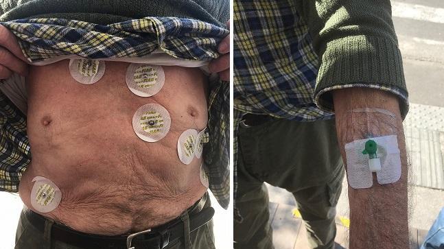 Dimesso con elettrodi e cannula ancora inseriti, l'Asl si scusa