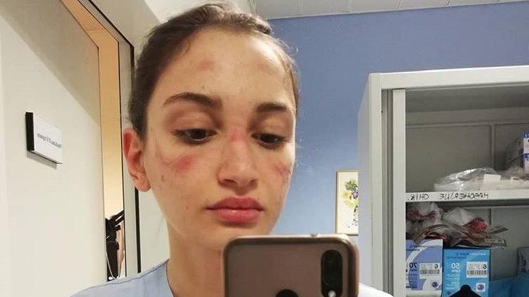 Alessia, l’infermiera toscana con i lividi per la mascherina: "State a casa, non vanificate i nostri sforzi"