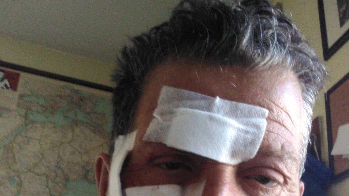 Gian Maria Massone porta sul volto i segni dell'aggressione subita nella sera di venerdì 19 giugno alla pizzeria "La Gastronomia"