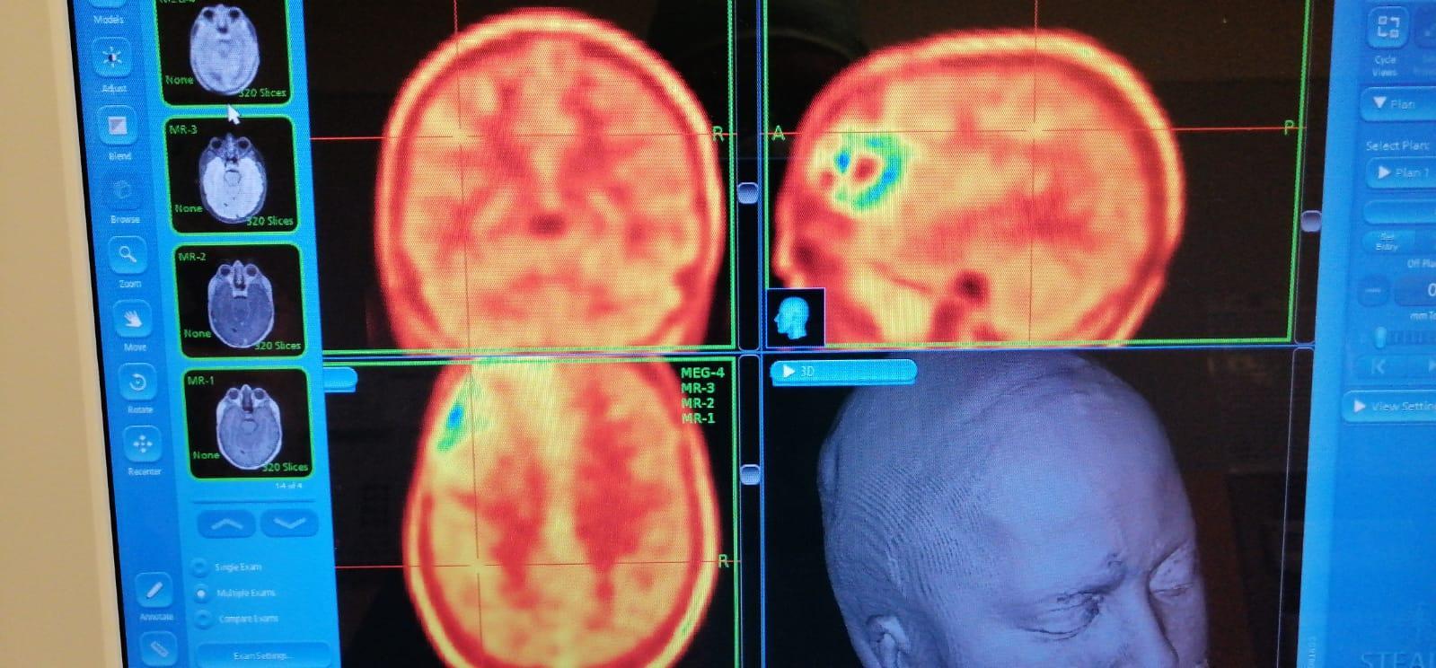 Al Santo Stefano un trattamento innovativo contro il tumore cerebrale