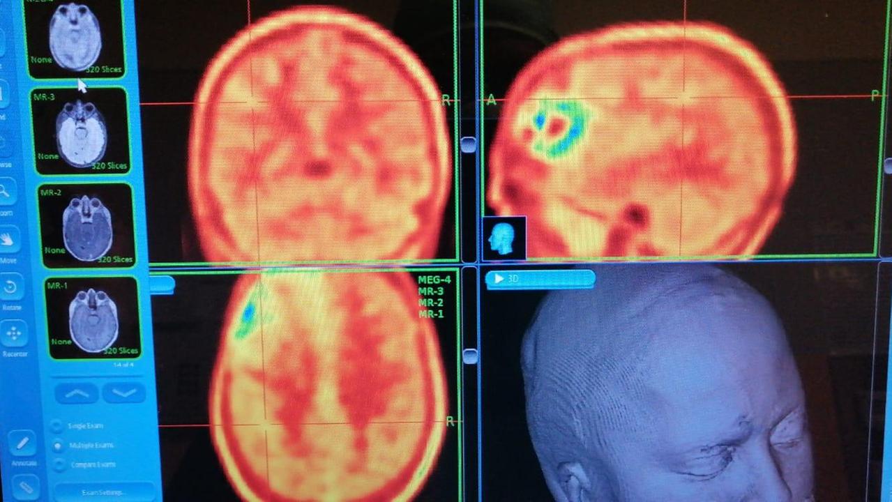Al Santo Stefano un trattamento innovativo contro il tumore cerebrale