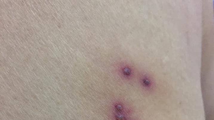 Morsa in pineta dal ragno violino, in Versilia un caso ogni anno