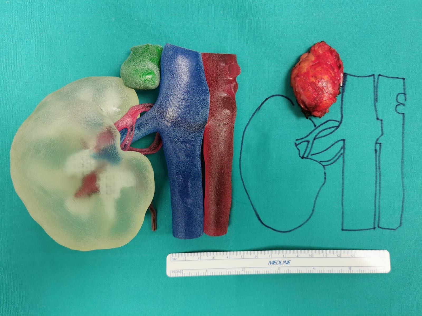 Il modellino in 3D dell'organo che ha subito l'intervento