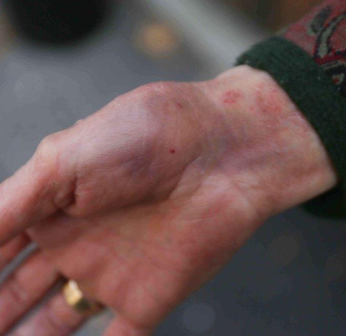«È stata male dopo la rapina con siringa» 
