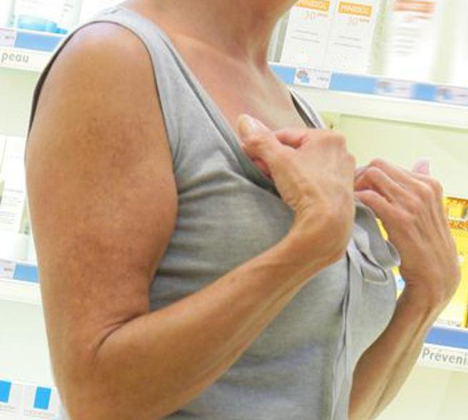 Aifa: orticaria cronica, stop al farmaco. I pazienti: «La Regione deve aiutarci» 