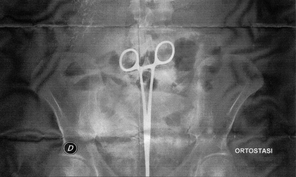 La radiografia dell’addome con la pinza dentro