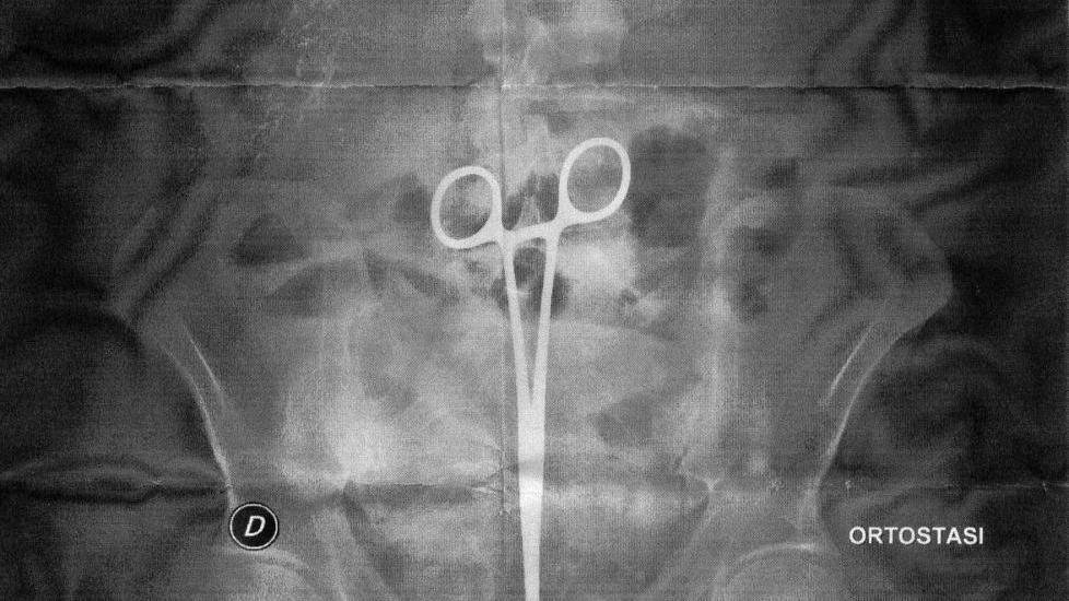 La radiografia dell’addome con la pinza dentro