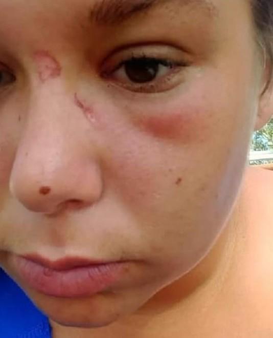 Il volto ferito di Irene nella foto pubblicata dalla madre su Facebook