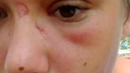 Il volto ferito di Irene nella foto pubblicata dalla madre su Facebook