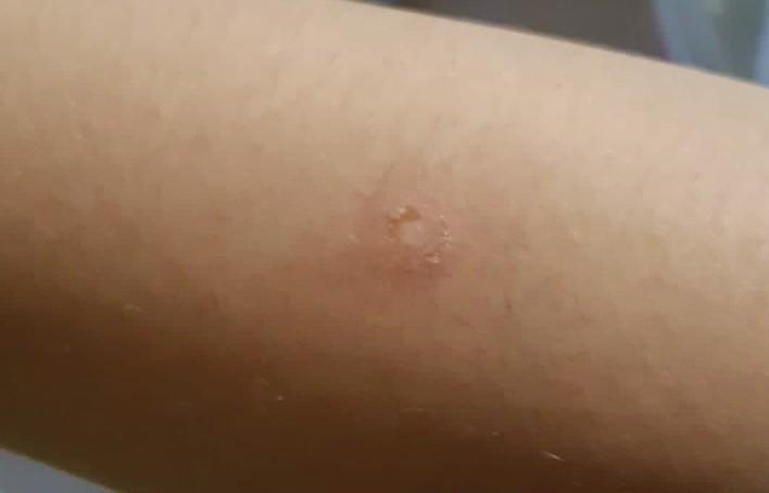 Bullismo a Sassari: «Mio figlio ustionato con una sigaretta» 