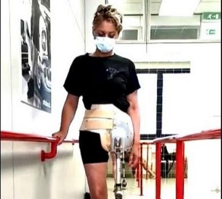 Laura Ruffato, 20 anni, con la sua vecchia protesi