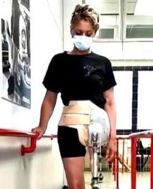 La raccolta fondi di Laura «Aiuto per la protesi nuova» 