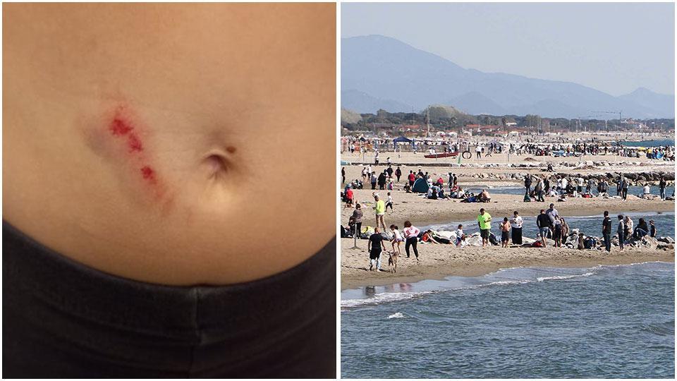 Marina di Massa, bambina di 6 anni aggredita da un cane in spiaggia. Il racconto choc del padre 