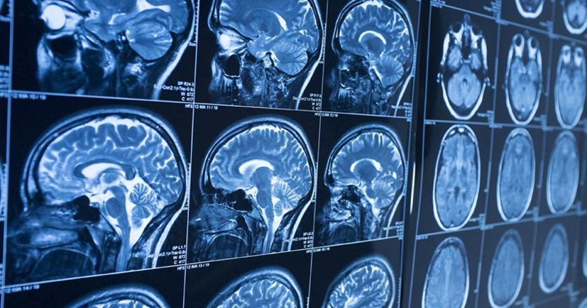 Neuroradiologia: la protagonista silenziosa della Sanità 
