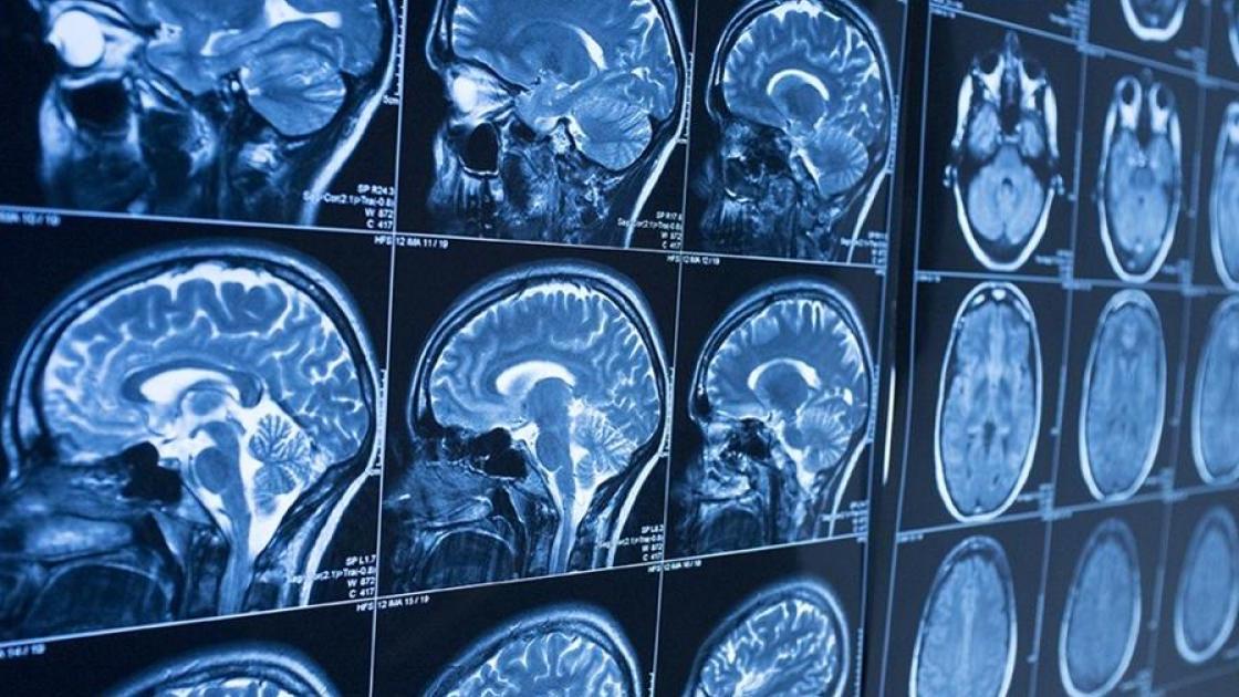 Neuroradiologia: la protagonista silenziosa della Sanità